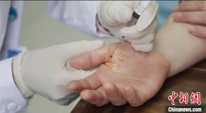 嘉善群眾體驗(yàn)小針刀?！〖紊平y(tǒng)戰(zhàn) 供圖